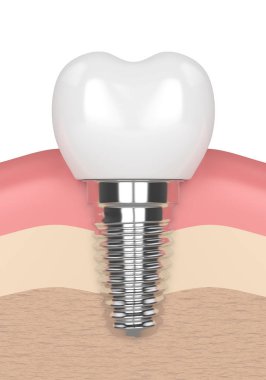dental implant diş etleri 3D render