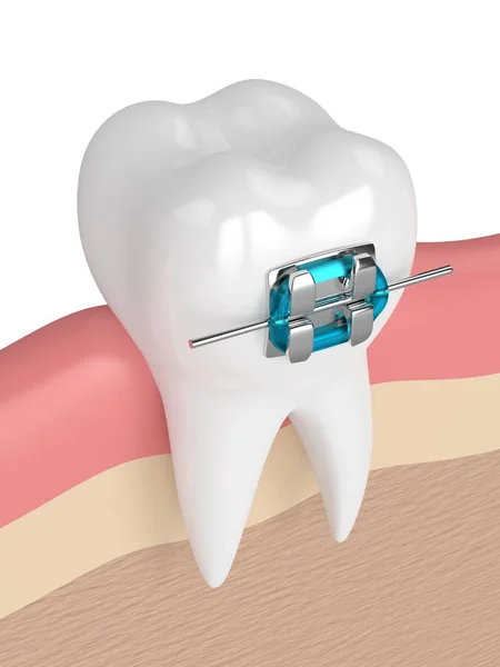 3d renderização de dente com cinta em gengivas — Fotografia de Stock