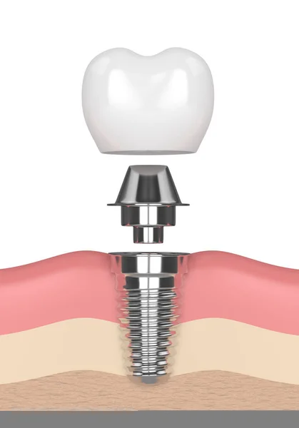 3D render van tandheelkundig implantaat in tandvlees — Stockfoto