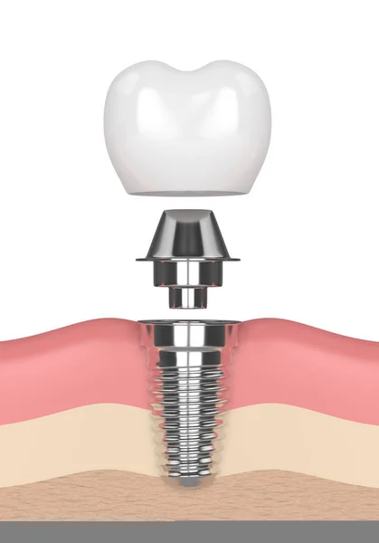 3d 牙种植体在牙龈中的呈现 — 图库照片