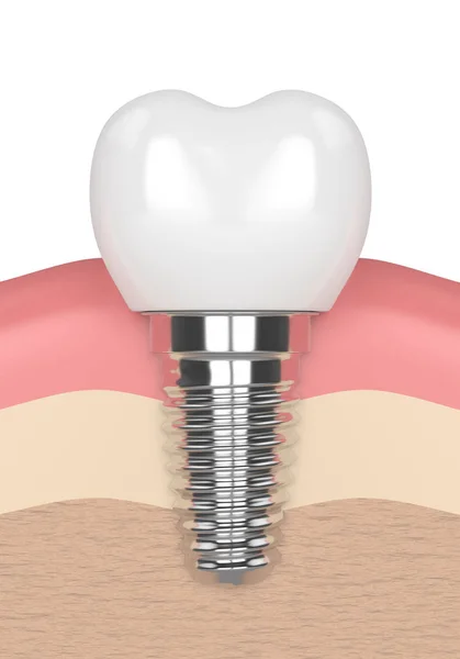 3d renderização de implante dentário em gengivas — Fotografia de Stock