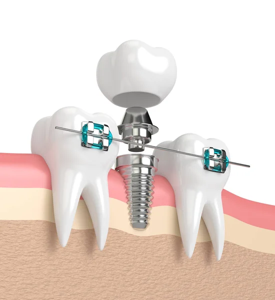 3D-Rendering von Zähnen mit Implantat und Zahnspange — Stockfoto