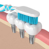 3D-Rendering von Zahnimplantaten mit Zahnbürste