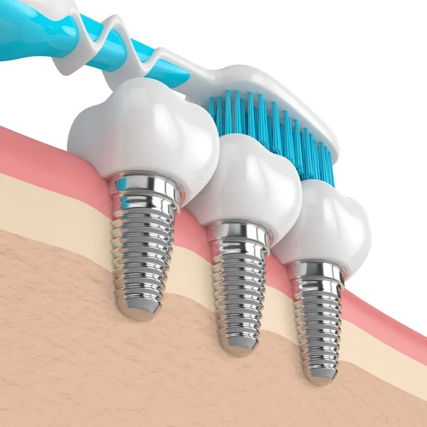 3D renderizado de implantes dentales con cepillo de dientes — Foto de Stock