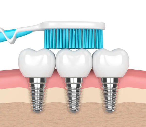 3d renderização de implantes dentários com escova de dentes — Fotografia de Stock