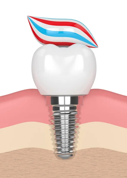 3d render of dental implant with toothpaste — Stock Photo, Image