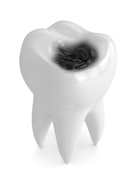 diş çürüğü ile 3D render