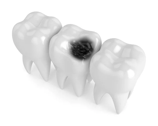 3D рендеринг зубов с распадом — стоковое фото