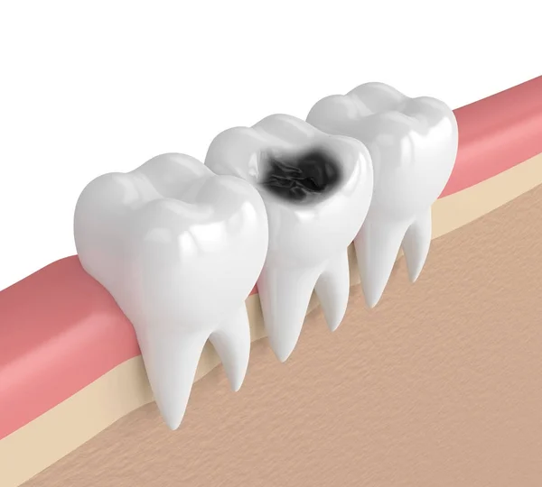 3d renderizado de dientes en encías con caries — Foto de Stock