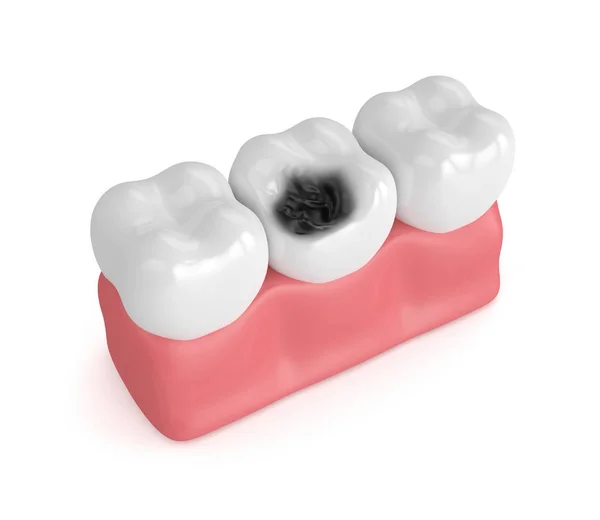 3d renderização de dentes em gengivas com decadência — Fotografia de Stock