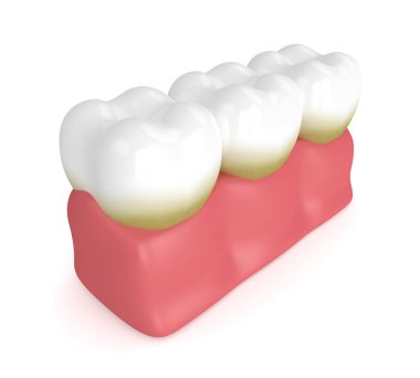 3d render of teeth with plaque and tartar clipart
