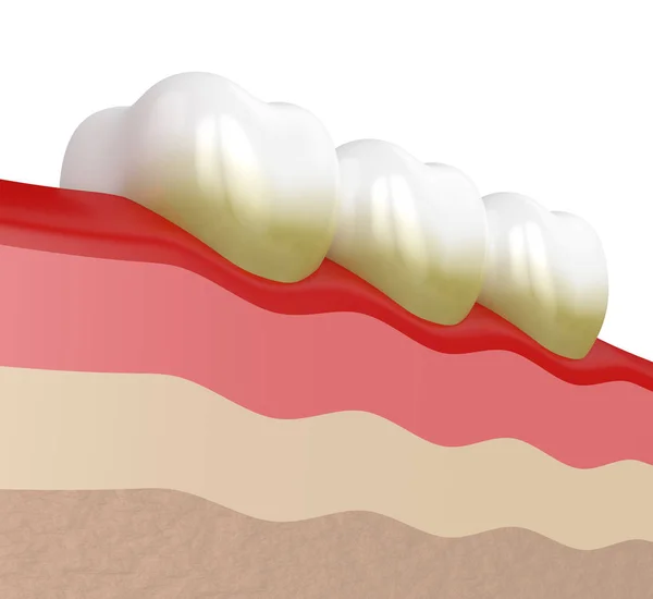 3D renderização de dentes com placa e tártaro — Fotografia de Stock