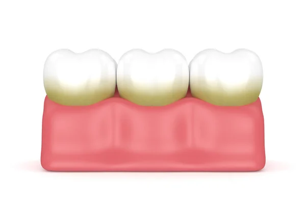 3D vykreslování ze zubů plak a zubní kámen — Stock fotografie