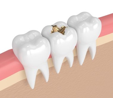 3d render of teeth with dental gold filling clipart