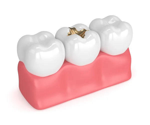 3d render of teeth with dental gold filling — Stock Photo, Image