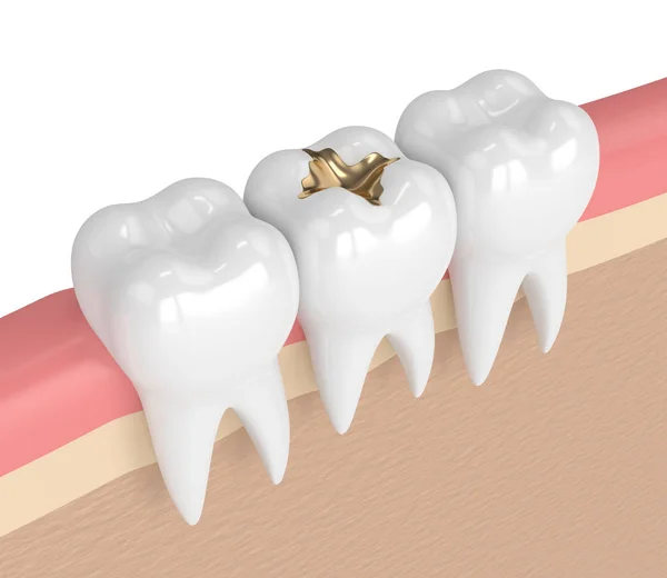 Rendement 3d des dents avec remplissage en or dentaire — Photo