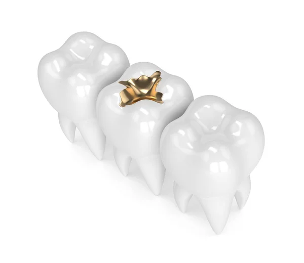 Odwzorowania 3D zębów z złotym wypełnienia stomatologiczne — Zdjęcie stockowe