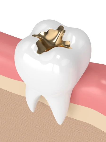 3d render of tooth with dental gold filling — Stock Photo, Image