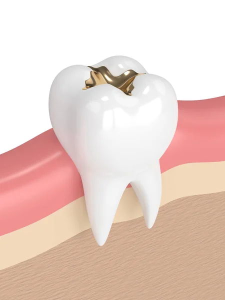 3d render of tooth with dental gold filling — Stock Photo, Image