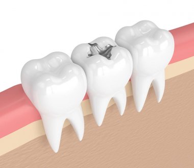 3d render of teeth with dental amalgam filling clipart