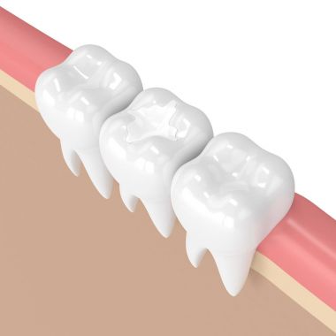3d render of teeth with dental composite filling clipart