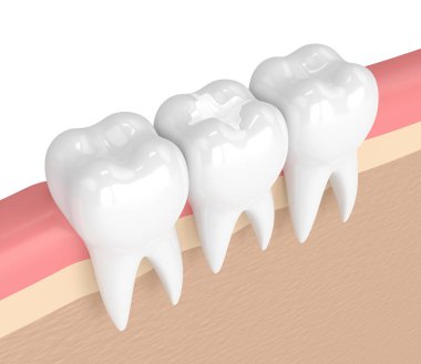3d render of teeth with dental composite filling clipart