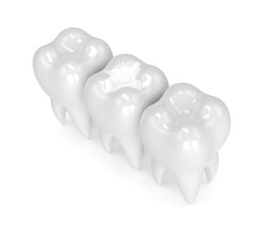 diş diş kompozit dolgu ile 3D render