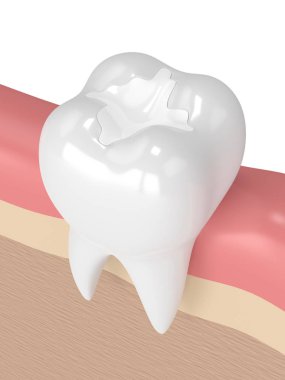 diş diş kompozit dolgu ile 3D render