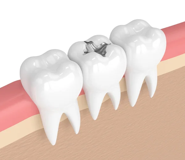 3d render of teeth with dental amalgam filling — Stock Photo, Image