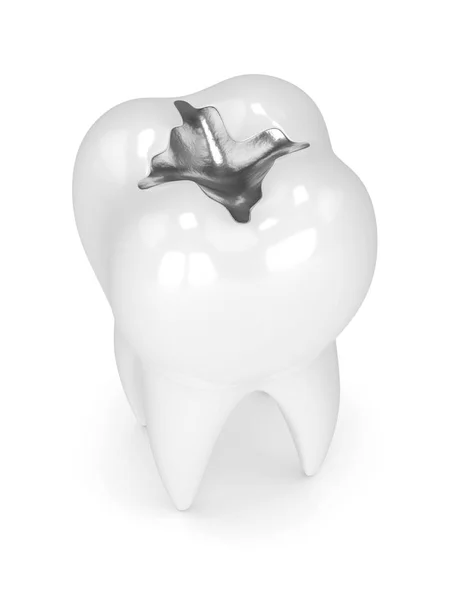 3D vykreslování zubu s náplní dentální amalgám — Stock fotografie