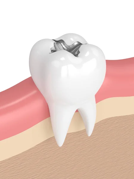 3D render fogak-a fogászati amalgám tömés — Stock Fotó