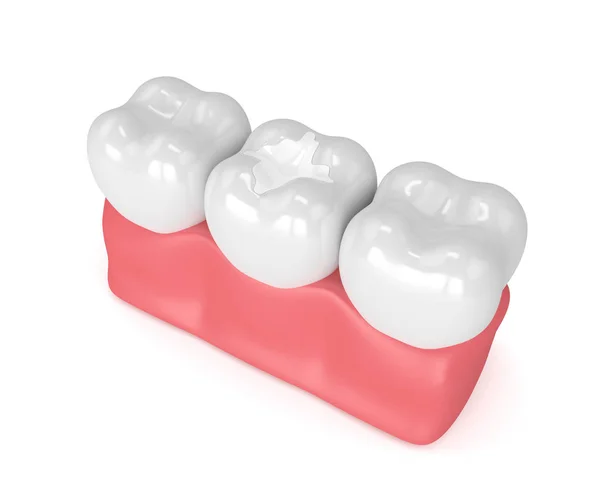 3D render tänder med dentala kompositmaterial fyllning — Stockfoto