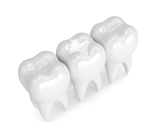 3D рендеринг зубов с зубным композитным наполнением
