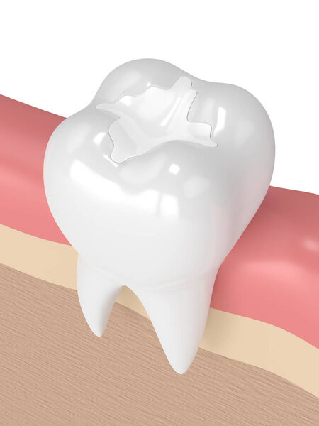 3D рендеринг зуба с зубным композитным наполнением
