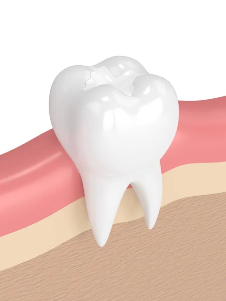3d renderização de dente com preenchimento composto dental — Fotografia de Stock