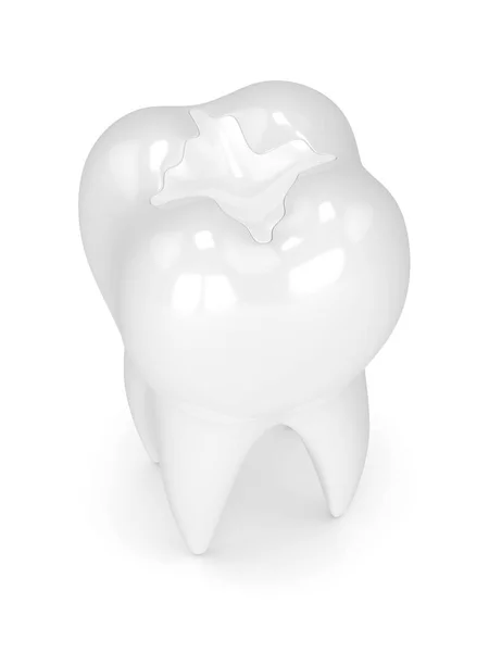 3d renderizado de diente con relleno compuesto dental — Foto de Stock