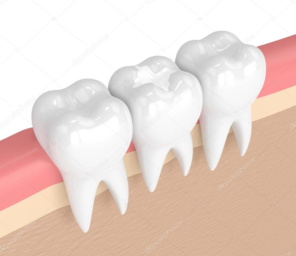 3d render of teeth with dental composite filling