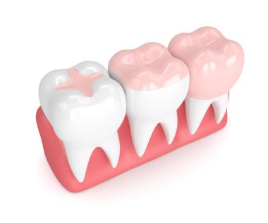 Diş dolgu farklı tipleri ile 3D render