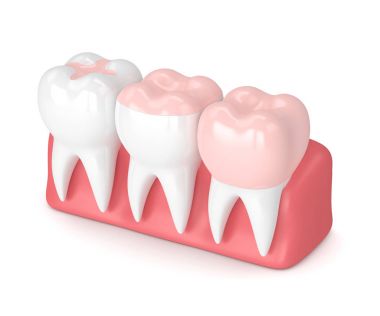 Diş dolgu farklı tipleri ile 3D render