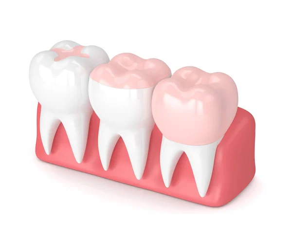 3D візуалізація зубів з різними типами пломбування — стокове фото