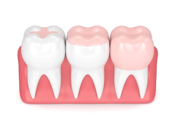 各種充填の歯の 3 d レンダリング — ストック写真