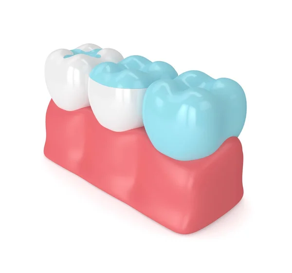 Odwzorowania 3D zębów z różnymi rodzajami paliw — Zdjęcie stockowe