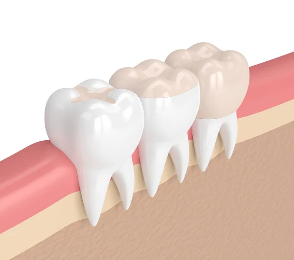 3d render of teeth with different types of filling — Stock Photo, Image