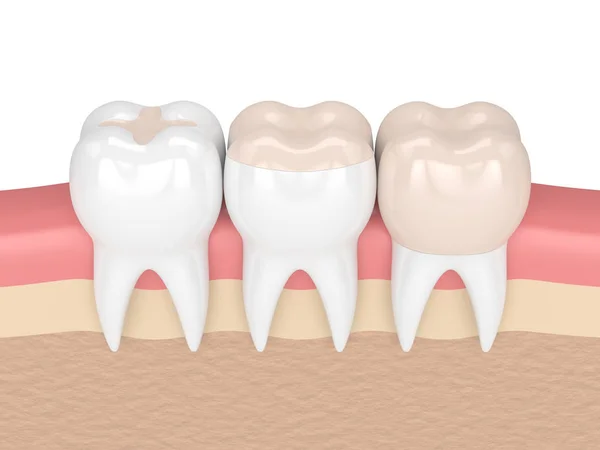 3d renderizado de dientes con diferentes tipos de relleno — Foto de Stock