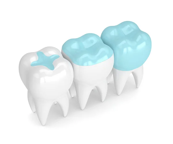 3d render of teeth with different types of filling — Stock Photo, Image