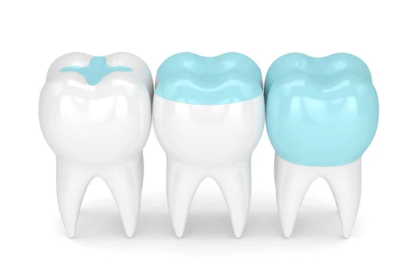 3d render of teeth with different types of filling — Stock Photo, Image