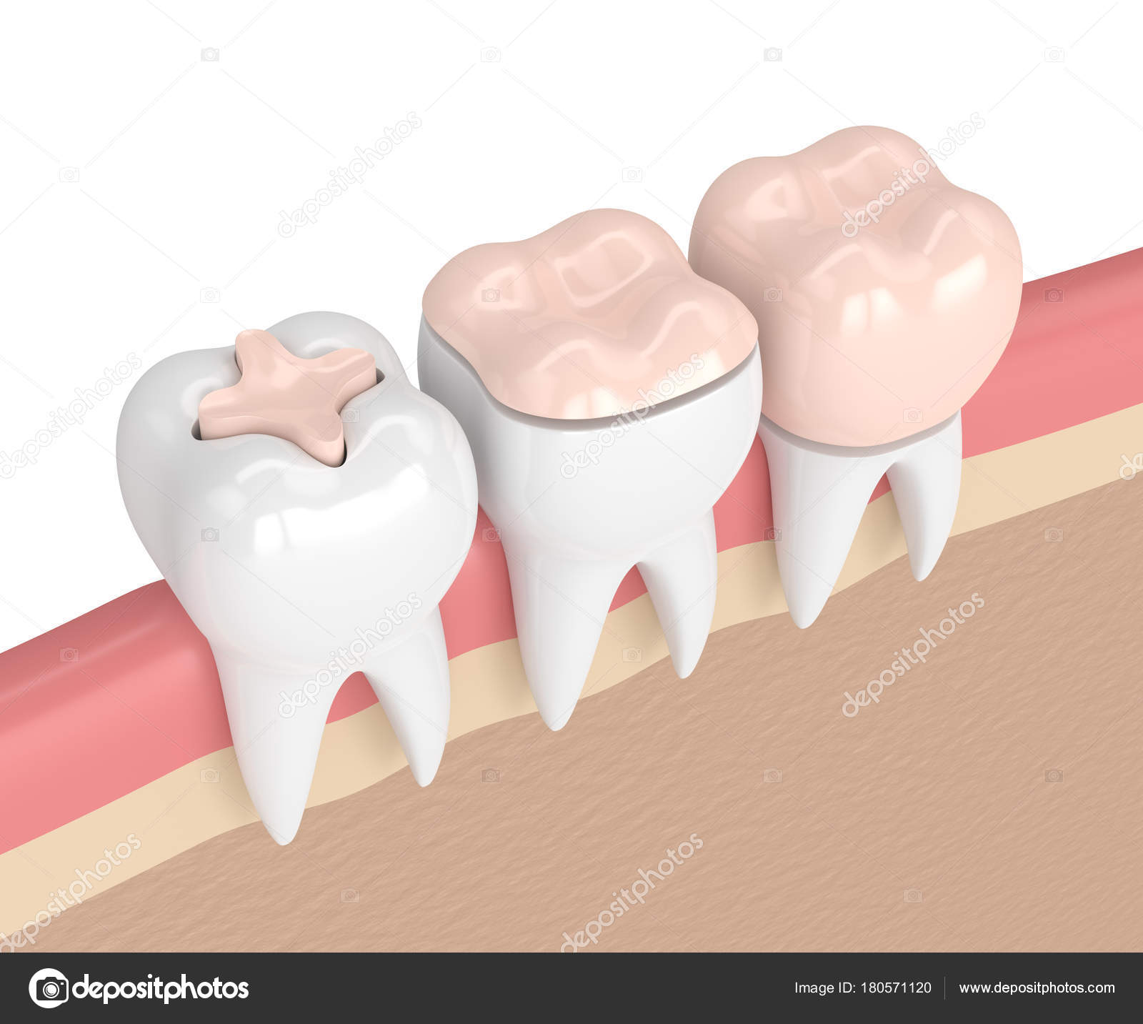 Вкладки микропротезы инлэй. Металлическая вкладка. Зубной протез культевая вкладка. Штифт коронка имплант разница. Вкладки, накладки зубные.