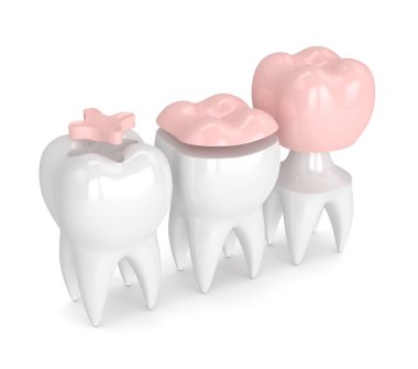 Diş dolgu farklı tipleri ile 3D render
