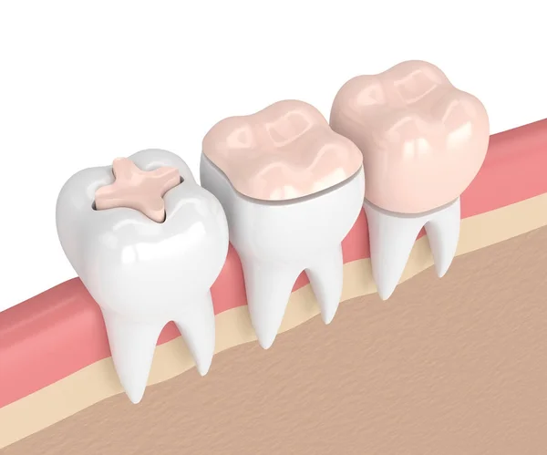 Rendering 3d di denti con diversi tipi di riempimento dentale — Foto Stock