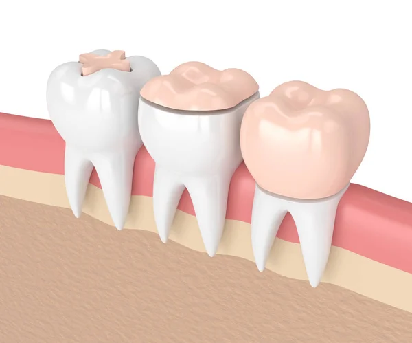 3d render of teeth with different types of dental filling — Stock Photo, Image